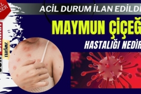 Maymun Çiçeği Virüsü Hastalığı Nedir?