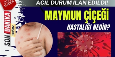 Maymun Çiçeği Virüsü Hastalığı Nedir?